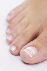 Ingrown Toenail Treatment